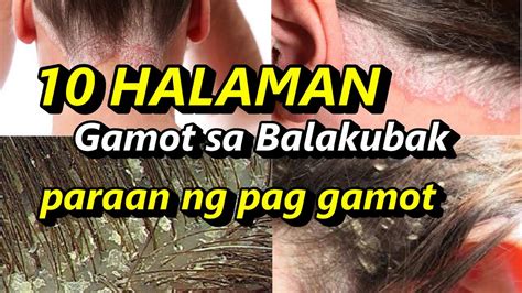 balakubak sa bulbol ni rastaman|Gamot Sa Balakubak .